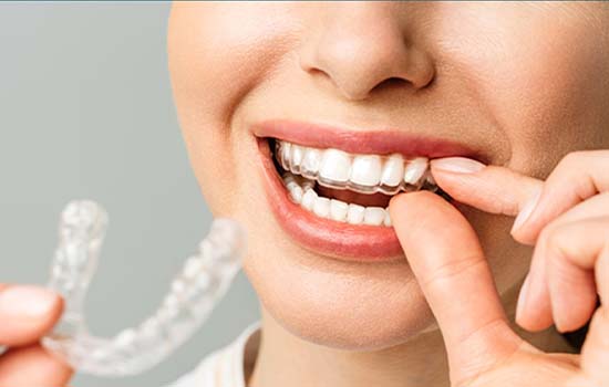 Invisalign: Bridging Tradition with Innovation in Modern Dentistry